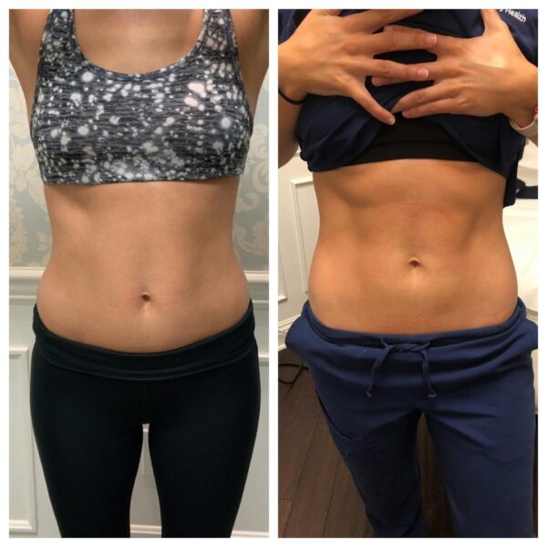 1634261901_emsculpt_abdomen_3_4_weeks_post_4_sessions_3