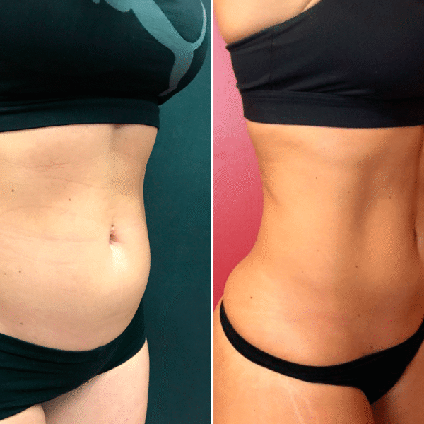 amanda-after-3-emsculpt-oblique-new-jersey